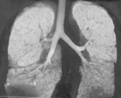 Increased Lung Density in the Bases Due to Scleroderma - CTisus CT Scan