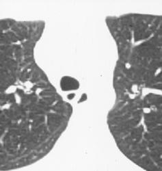 Outpouching of Trachea From Prior Te Fistulae Repair - CTisus CT Scan