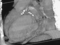 Calcified Coronary Arteries - CTisus CT Scan