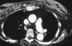 Prior Silicone Breast Injections - CTisus CT Scan