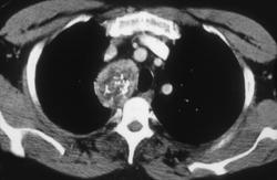 Substernal Thyroid - CTisus CT Scan