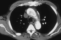 Aortic Dissection - CTisus CT Scan