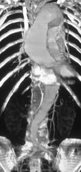 Dilated Ascending Aorta - CTisus CT Scan