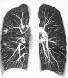 Granulomatous Disease - CTisus CT Scan