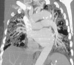 Pulmonary Hypertension - CTisus CT Scan