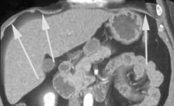 3D of the Diaphragm - CTisus CT Scan