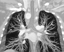 Right Aortic Arch - CTisus CT Scan