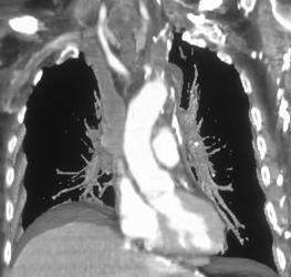 SVC Occlusion With Collaterals - CTisus CT Scan