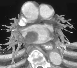 Tumor Thrombus in the Atrium - CTisus CT Scan