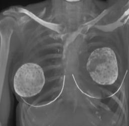 Breast Implants That Have Calcified - CTisus CT Scan