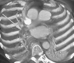 Pulmonary Embolism - CTisus CT Scan