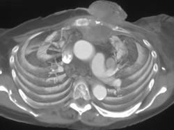 Breast Cancer Invades the Chest Wall - CTisus CT Scan