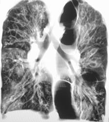 Cystic Fibrosis - CTisus CT Scan