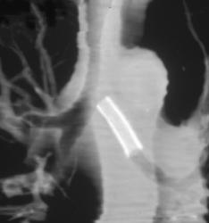 Stent in the Airway in 3D - CTisus CT Scan