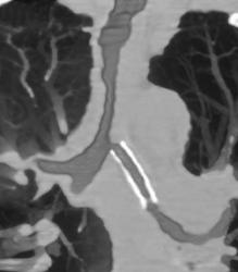 Stenosis of the Left Mainstem Bronchus With A Stent - CTisus CT Scan