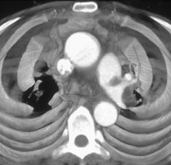 Pulmonary Embolism - CTisus CT Scan