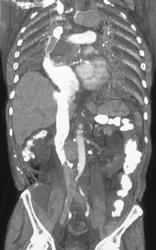 Reflux Down the Inferior Vena Cava (IVC) - CTisus CT Scan