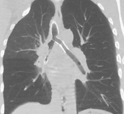 Multiple Stents in the Airway in A Patient With Hcl Exposure - CTisus CT Scan