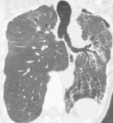 Bronchiectasis - CTisus CT Scan