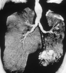 Dilated Trachea and Bronchiectasis Due to Prior Episode of Acute Respiratory Distress Syndrome (ARDS) - CTisus CT Scan