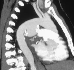 Ductus Artery Aneurysm - CTisus CT Scan