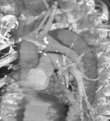 Coronary Artery Bypass and Aortic Dissection - CTisus CT Scan