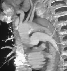 Aortic Dissection - CTisus CT Scan