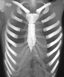 3D Chest Wall (normal) - CTisus CT Scan