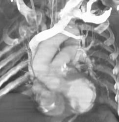 Superior Intercostal Vein - CTisus CT Scan