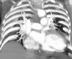 Aberrant Right Subclavian Artery - CTisus CT Scan