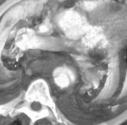 Traumatic Aortic Dissection - CTisus CT Scan