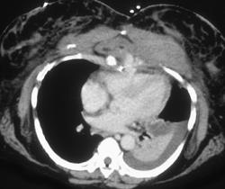 Leak From Right Ventricle - CTisus CT Scan