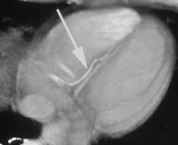 Coronary Artery Scanning - CTisus CT Scan