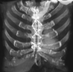 Nonunion Following Sternal Repair - CTisus CT Scan