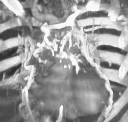 Varices Around the Pericardium in Patient With SVC Occlusion - CTisus CT Scan