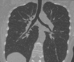 Patient Airways in 3D - CTisus CT Scan