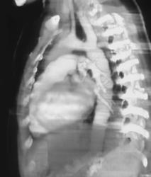 Aortic Coarctation Post Repair - CTisus CT Scan