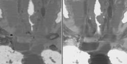 Tracheal Stenosis Post Intubation - CTisus CT Scan