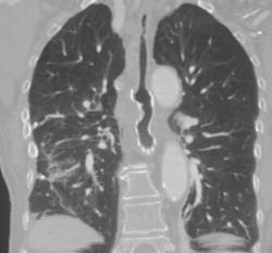 Stent in Esophageal Cancer - CTisus CT Scan