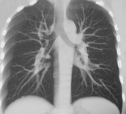 Normal Airways With VRT and MIP - CTisus CT Scan