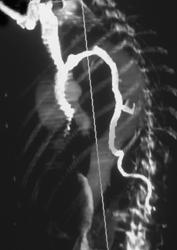 Prominent Azygos Vein - CTisus CT Scan