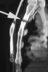 Osteomyelitis - CTisus CT Scan