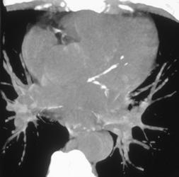 Coronary Artery Calcification - CTisus CT Scan