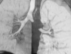 Occlusion Left Mainstem Bronchus Due to Inflammation (collapsing Left Mainstem Bronchus) - CTisus CT Scan