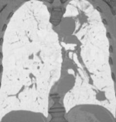 Lung Cancer - CTisus CT Scan