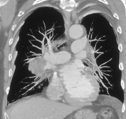 Carcinoma in the Right Hilum - CTisus CT Scan