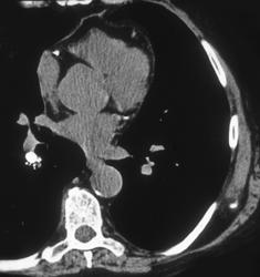 Coronary Calcification in the LAD - CTisus CT Scan