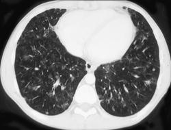 Eosinophilic Pneumonia - CTisus CT Scan