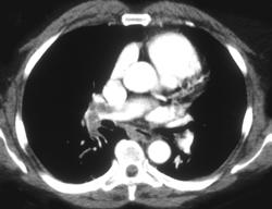 Pulmonary Embolism - CTisus CT Scan