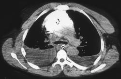 Contrast Extravasation in Anterior Mediastinum - CTisus CT Scan